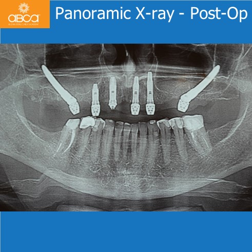 Panoramic X-ray - Post-Op
