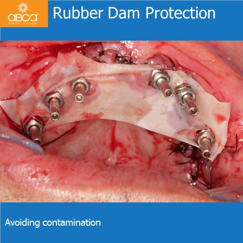 Rubber Dam Protection | Avoiding contamination