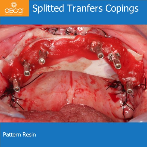 Splitted Tranfers Copings | Pattern Resin