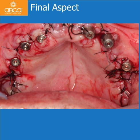 Final Aspect