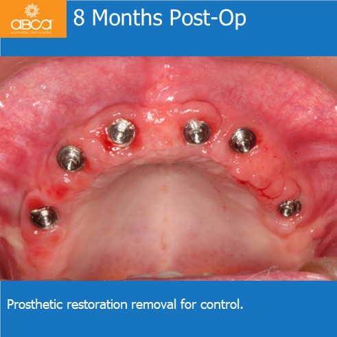 8 Months Post-Op | Prosthetic restoration removal for control.