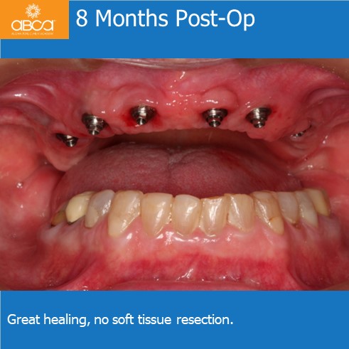 8 Months Post-Op | Great healing, no soft tissue resection.