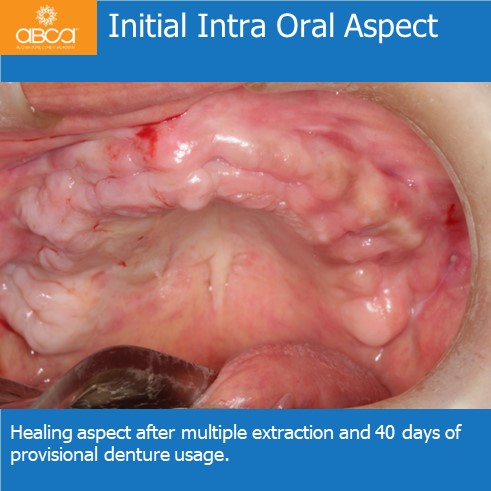 Initial Intra Oral Aspect | Healing aspect after multiple extraction and 40 days of provisional denture usage.