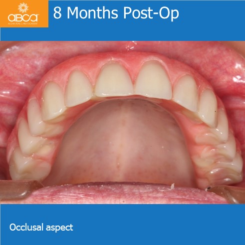 8 Months Post-Op | Occlusal aspect