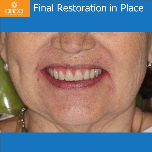 Final Restoration in Place
