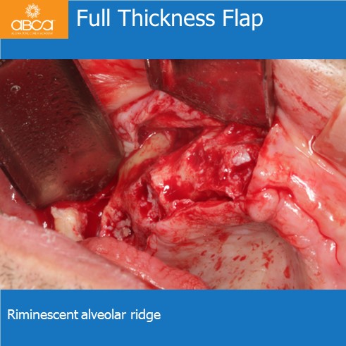 Full Thickness Flap | Riminescent alveolar ridge