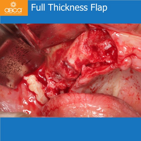Full Thickness Flap