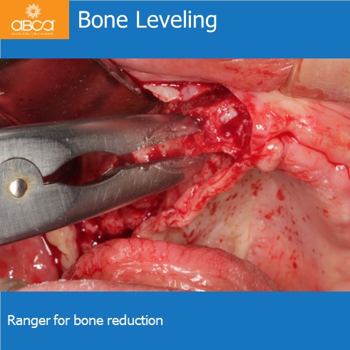 Bone Leveling | Ranger for bone reduction