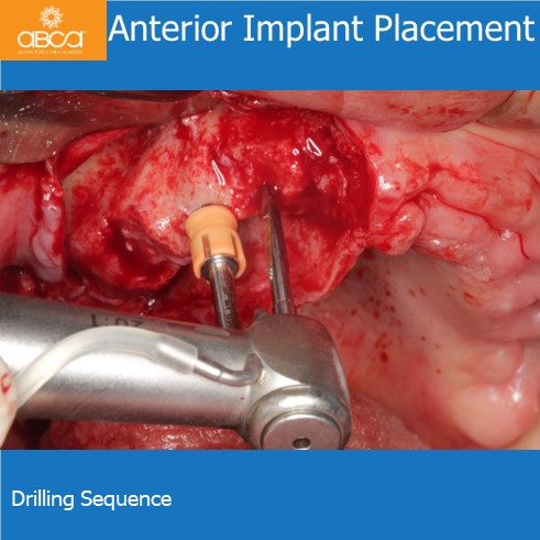 Anterior Implant Placement | Drilling Sequence
