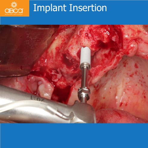 Implant Insertion