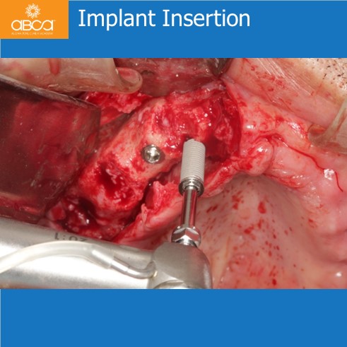 Implant Insertion