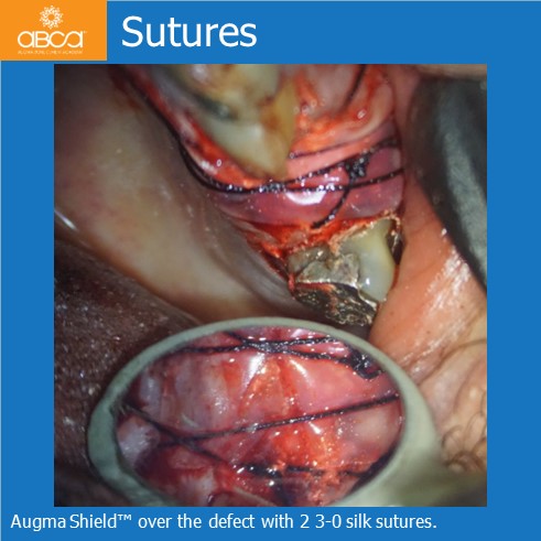 Sutures | Augma Shield™ over the defect with 2 3-0 silk sutures.
