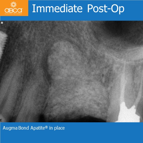 Immediate Post-Op | Augma Bond Apatite® in place