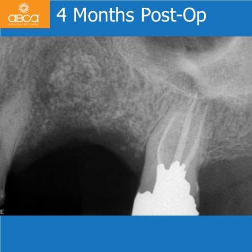 4 Months Post-Op