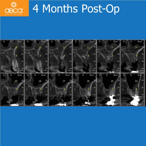 4 Months Post-Op