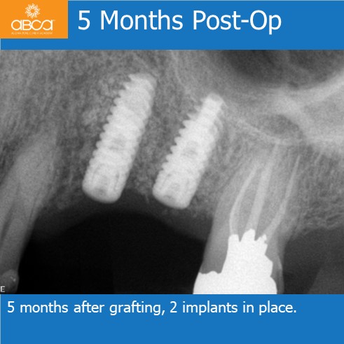 5 Months Post-Op | 5 months after grafting, 2 implants in place.