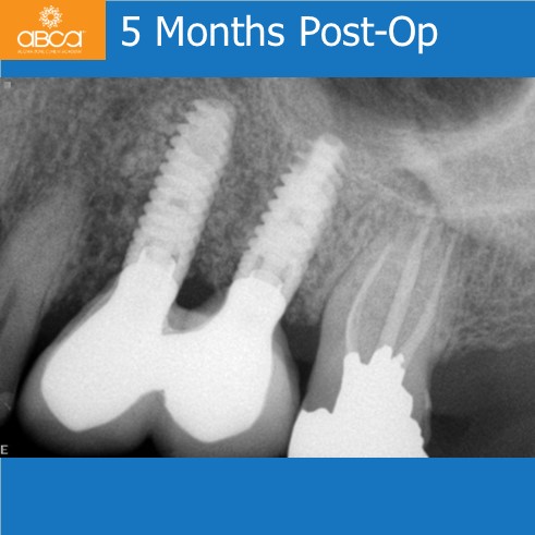 5 Months Post-Op