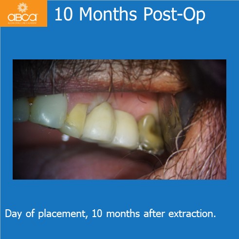10 Months Post-Op | Day of placement, 10 months after extraction.