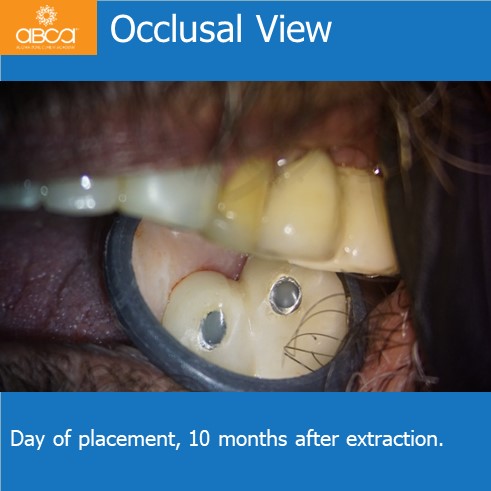 Occlusal View | Day of placement, 10 months after extraction.
