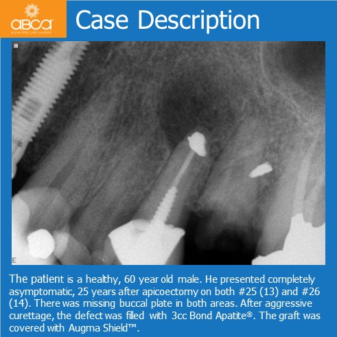 Case Description | The patient is a healthy, 60 year old male. He presented completely asymptomatic, 25 years after apicoectomy on both #25 (13) and #26 (14). There was missing buccal plate in both areas. After aggressive curettage, the defect was filled with 3cc Bond Apatite®, The graft was covered with Augma Shield.