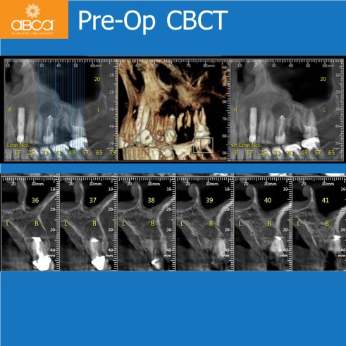 Pre-Op CBCT