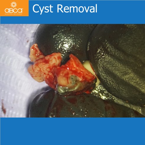 Cyst Removal