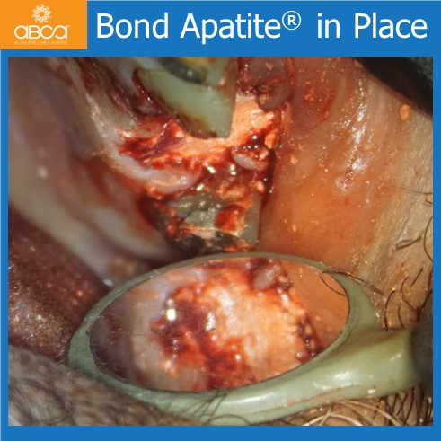 Bond Apatite® in Place