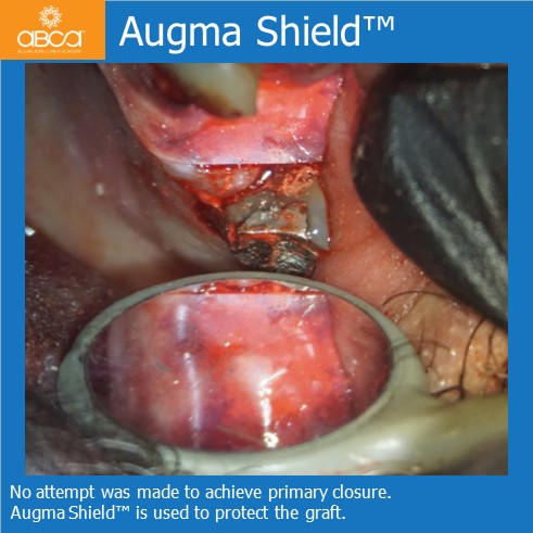 Augma Shield™ | No attempt was made to achieve primary closure. Augma Shield™ is used to protect the graft.