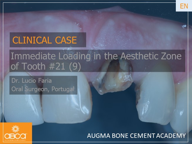 Immediate Loading in the Aesthetic Zone of Tooth