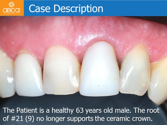 Immediate Loading in the Aesthetic Zone of Tooth