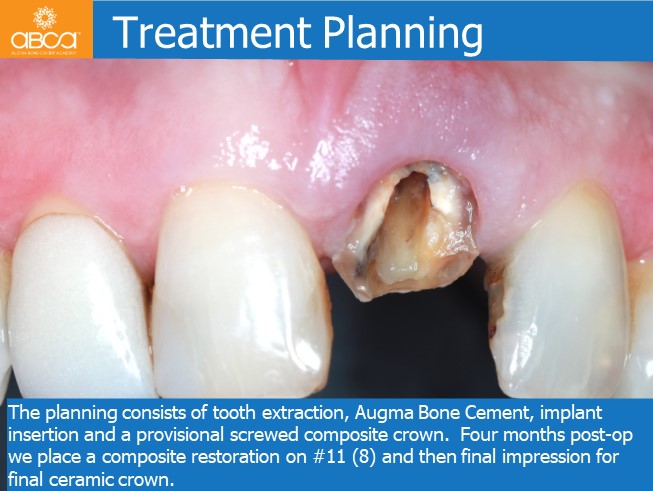 Immediate Loading in the Aesthetic Zone of Tooth