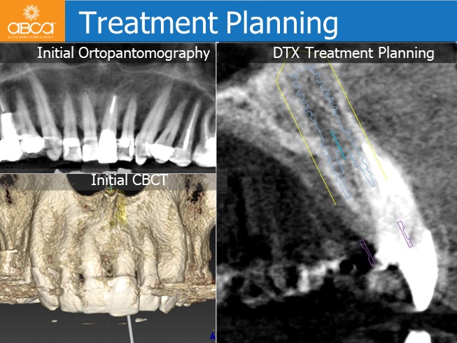 Immediate Loading in the Aesthetic Zone of Tooth