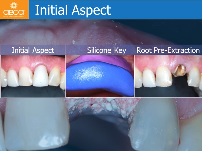 Immediate Loading in the Aesthetic Zone of Tooth