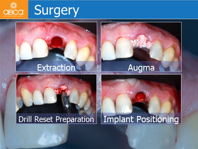 Immediate Loading in the Aesthetic Zone of Tooth