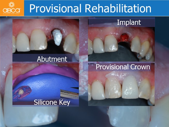 Immediate Loading in the Aesthetic Zone of Tooth