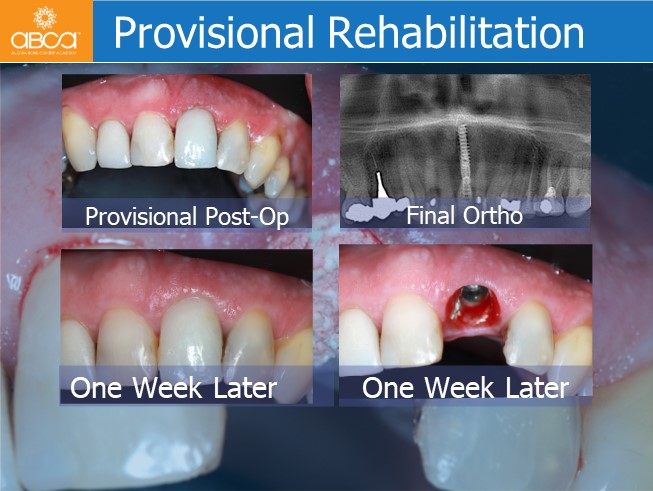 Immediate Loading in the Aesthetic Zone of Tooth