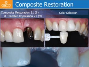 Immediate Loading in the Aesthetic Zone of Tooth