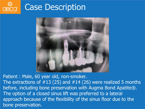 Closed Sinus Lift with Augma Bond Apetite