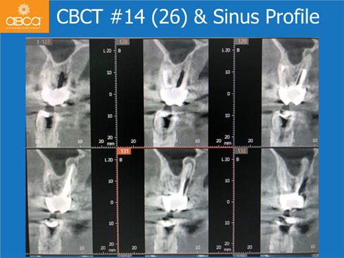 Closed Sinus Lift with Augma Bond Apetite