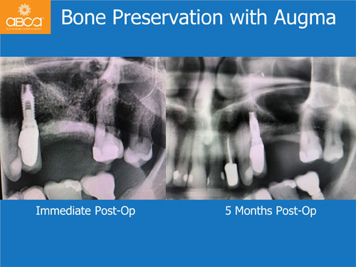 Closed Sinus Lift with Augma Bond Apetite