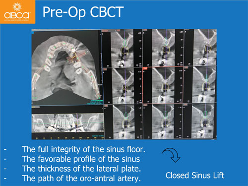 Closed Sinus Lift with Augma Bond Apetite