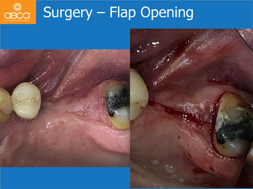 Closed Sinus Lift with Augma Bond Apetite