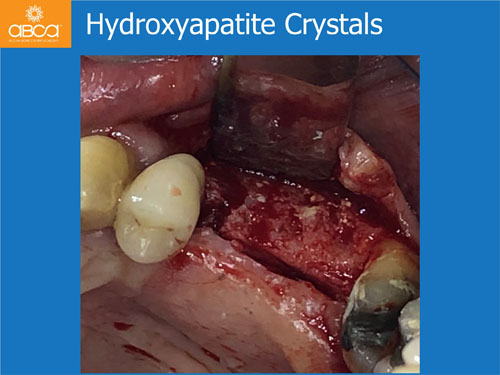 Closed Sinus Lift with Augma Bond Apetite