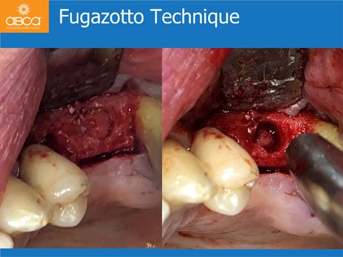 Closed Sinus Lift with Augma Bond Apetite