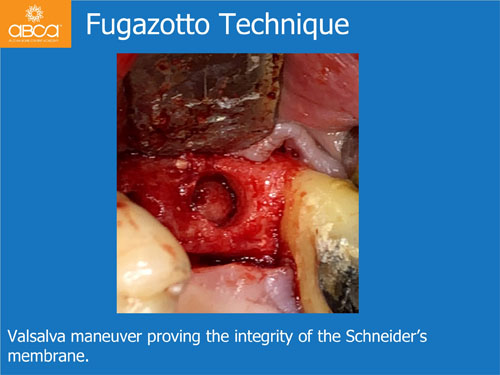 Closed Sinus Lift with Augma Bond Apetite