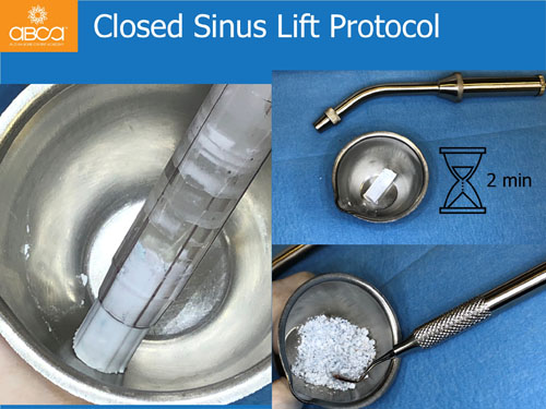 Closed Sinus Lift with Augma Bond Apetite