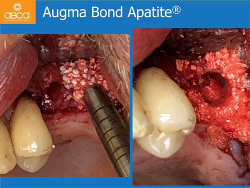 Closed Sinus Lift with Augma Bond Apetite