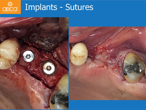 Closed Sinus Lift with Augma Bond Apetite