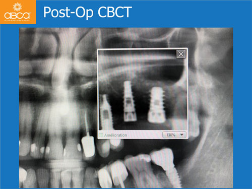 Closed Sinus Lift with Augma Bond Apetite