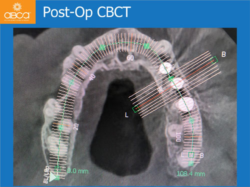 Closed Sinus Lift with Augma Bond Apetite